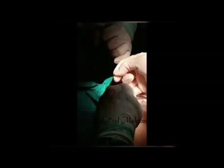 Left Diaphragmatic Tear
