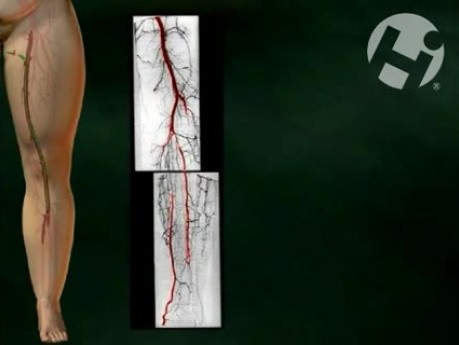 Compartment Syndrome
