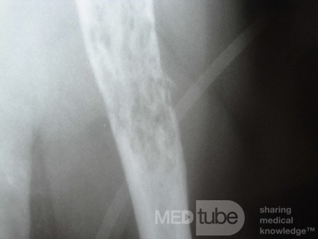 Colon Angiodysplasia and Multiple Myeloma (18 of 24)
