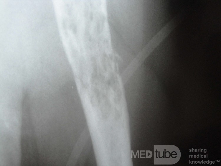 Colon Angiodysplasia and Multiple Myeloma (18 of 24)