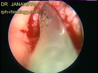 Laryngeal Papillomatosis