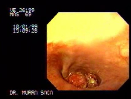 Adenocarcinoma of Cardia and Esophagus