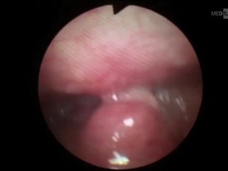 Ectopic Thyroid in Throat (Base of Tongue)