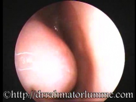 Chronic Sinusitis As Predisposing Factor To Middle Ear Effusion Formation