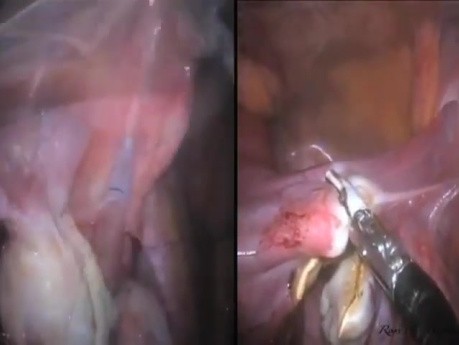 LESS Cholecystectomy with Concomitant Total Hysterectomy & Bilateral Salpingo-Oophorectomy