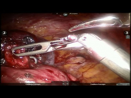 Anatomic Lung Resection - Lingula Sparing Left Upper Lobectomy
