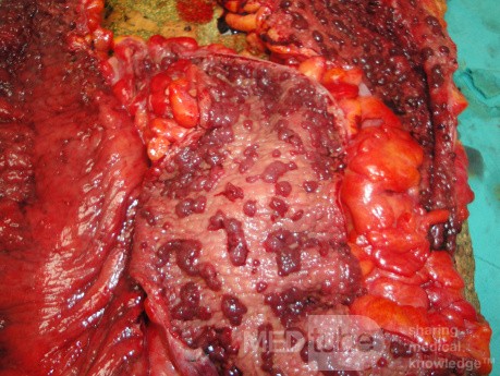 Multiple Rectal Ulcers (83 of 110)