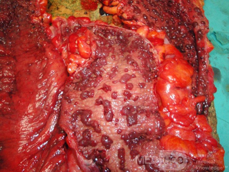 Multiple Rectal Ulcers (83 of 110)