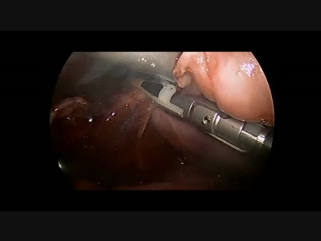 Thoracoscopic resection of ganglioneuroblastoma in 1 year-old child