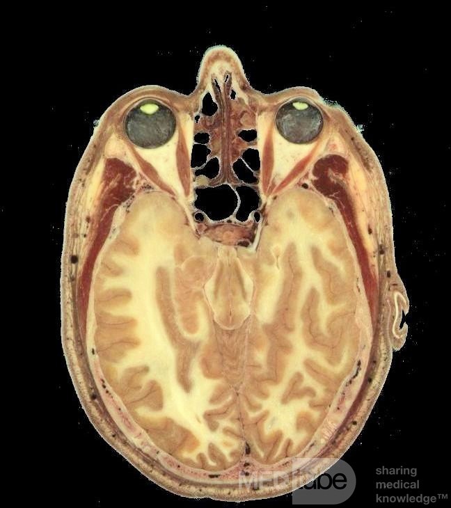 The Relationship of the Lateral Wall of the Ethmoid Sinuses to the Medial Rectus Muscle