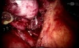 Robotic Choledochal Cyst Excision with Biliary Reconstruction