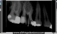 Endodontic Perforation - Hints To Help You When It Happens To You