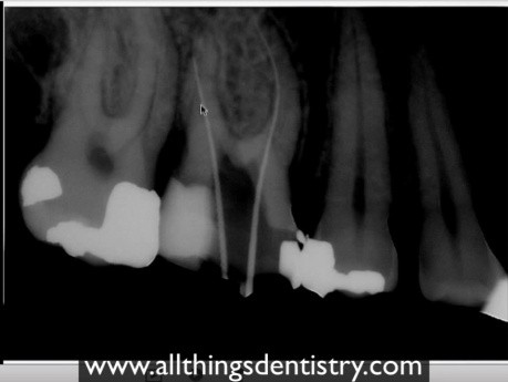 Endodontic Perforation - Hints To Help You When It Happens To You