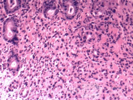 Endoscopy of Scirrhous Gastric Carcinoma involving the entire Fundus, Body and the Antrum (5 of 47)