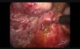 Laparoscopic C.B.D Exploration (Post Cholecystectomy)