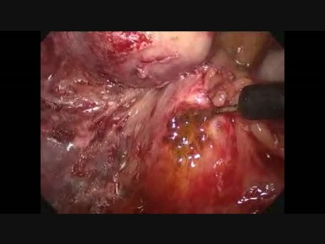 Laparoscopic C.B.D Exploration (Post Cholecystectomy)