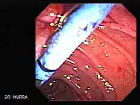 Adenocarcinoma of the Vater Papilla - Stent Migration (6 of 7)