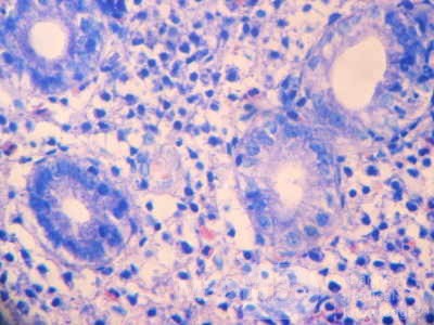 Eosinophilic Gastritis (7 of 7)