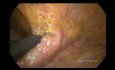 Simple and Universal Approach for the Splenic Flexure Mobilization
