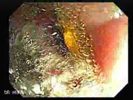 Dental Prothesis Found in the Jejuno (5 of 9)