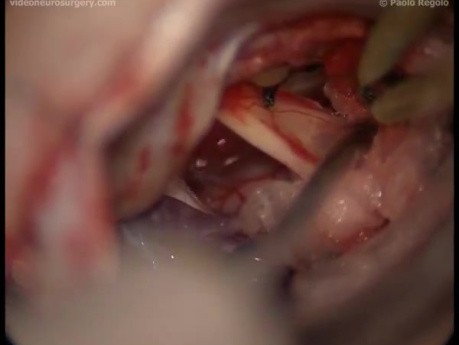 Glossopharyngeal Schwannoma - Right-Retrosigmoid Approach