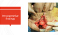 Inguinal Hernia with Difficult Anatomy