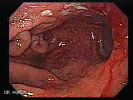 Primary Gastric Lymphoma Following Kidney Transplantation - Closer Look at the Mucosa
