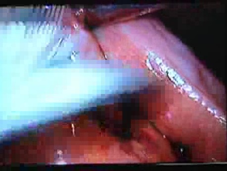 Jejunal Gastrointestinal Stromal tumor (GIST) (71 of 86)