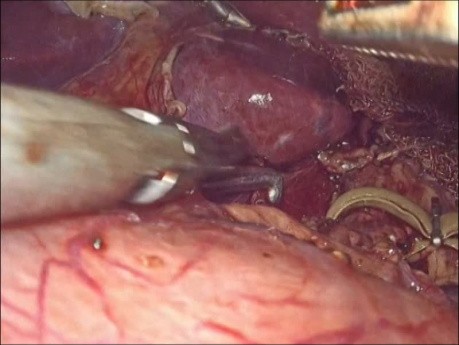 Laproscopic Surgery for Median Arcuate Ligament Syndrome 