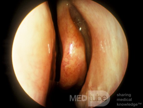 Elongated Middle Turbinate [left]