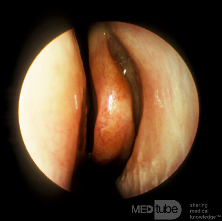 Elongated Middle Turbinate [left]