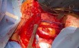 Complete Heart Decompression During Bilateral Lung Transplantation