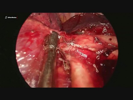 Live Surgery: Complex Uniportal VATS Left Upper Lobectomy