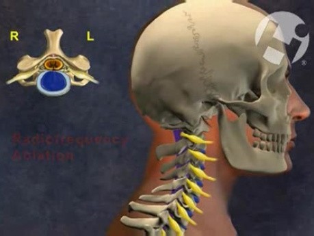 Hyperextension and Central Cord Syndrome