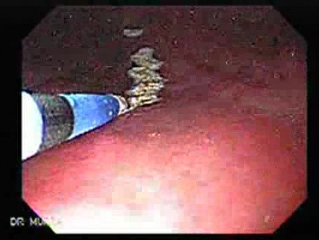 Watermelon Stomach (2 of 7) - Treatment with Argon Plasma Coagulator (APC)