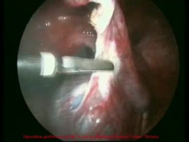 Surgery of Ovarian Cyst - Laparoscopic Method