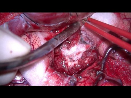 Right Insular Glioma. Transsylvian Resection.