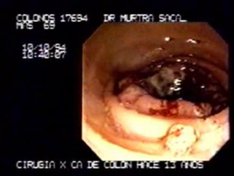 Metachronous Carcinoma