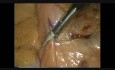 Laparoscopic Dissection and Exposure of Inferior Mesenteric Artery In Colo-Rectal Surgery For Cancer