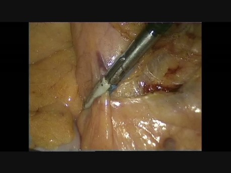 Laparoscopic Dissection and Exposure of Inferior Mesenteric Artery In Colo-Rectal Surgery For Cancer