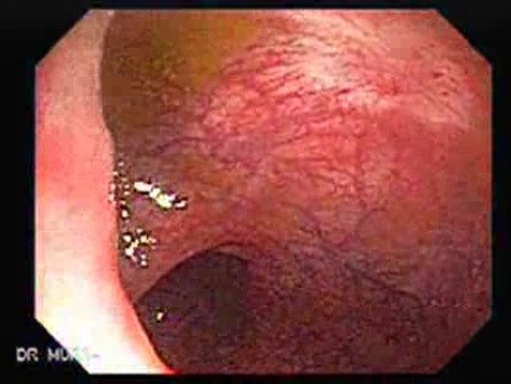 Status Post Rubber Band Treatment for Internal Hemorrhoids (1 of 3)