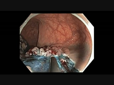 Colonoscopy - Rectum - Laterally Spreading Granular Tumor - EMR Part II