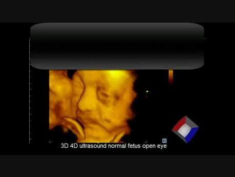 3D 4D Ultrasound Normal Fetus Open Eye