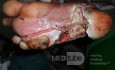Neglected Infected Diabetic Foot
