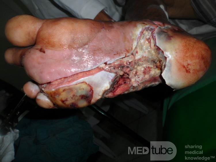 Neglected Infected Diabetic Foot