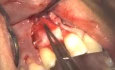 Implant Placement With Simultaneous Bone Augmentation - Case 1