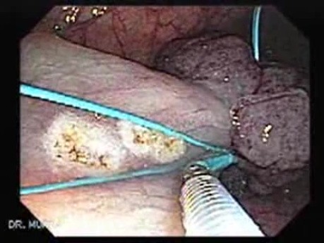 Huge Mass Of The Descending Colon (11 of 25)