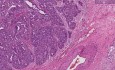Adenocarcinoma - Histopathology of ovary
