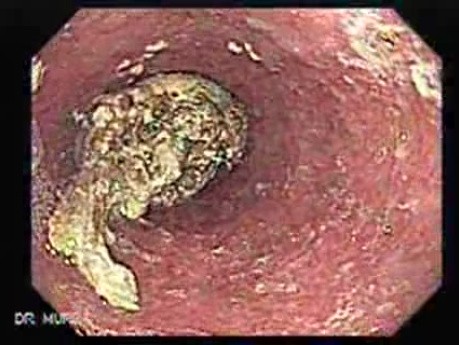 Esophageal Achalasia - 65 Year-Old Female. Impaction of Foreign Body.