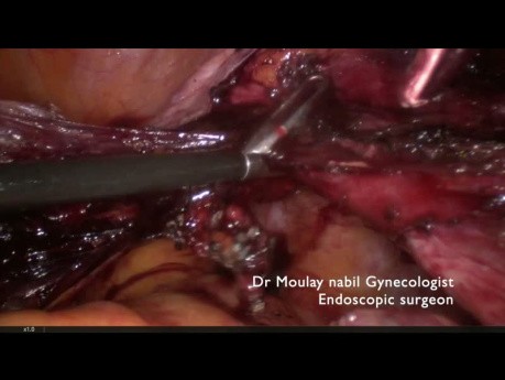 Hysterectomy and in Bag Extraction for Atypical Myoma